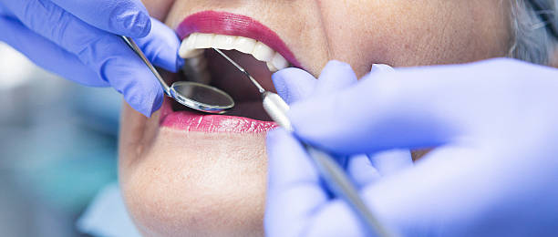 Best Knocked-Out Tooth (Avulsed Tooth) Treatment in Lake Lakengren, OH
